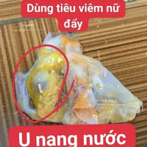 Đọc kết quả mảng viêm từ viên đặt phụ khoa Tiêu Viêm Nữ và các loại bệnh phụ khoa