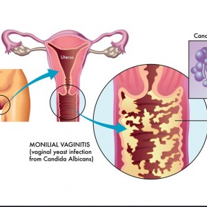 Viên đặt phụ khoa tiêu viêm nữ có chữa được nấm Candida ở âm đạo được không?