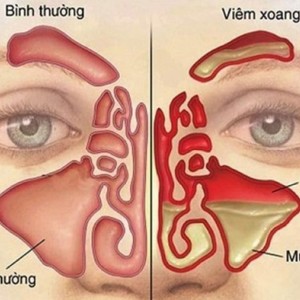 Các Cách Chữa Xoang Tại Nhà - Cùng Tiêu Viêm Nữ