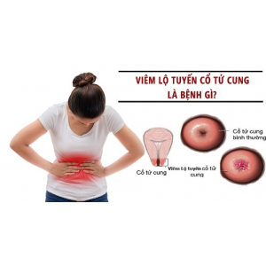 Sản phẩm viên đặt phụ khoa tiêu viêm nữ Hoàng Sơn có chữa được không viêm lộ tuyến cổ tử cung  tại nhà  không? 